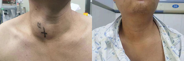 术前、术后患者颈部情况对比